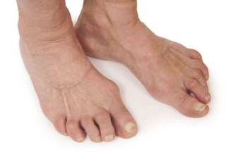 Osteoarthritis