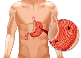 Stomach Ulcer